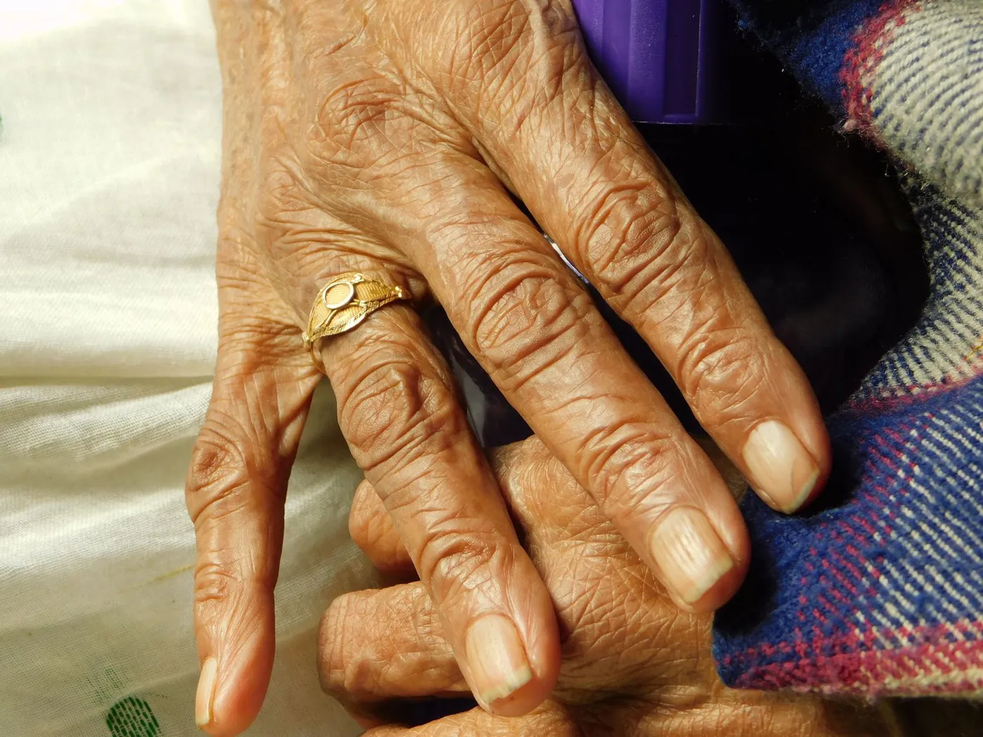 An elderly hand with painful joints