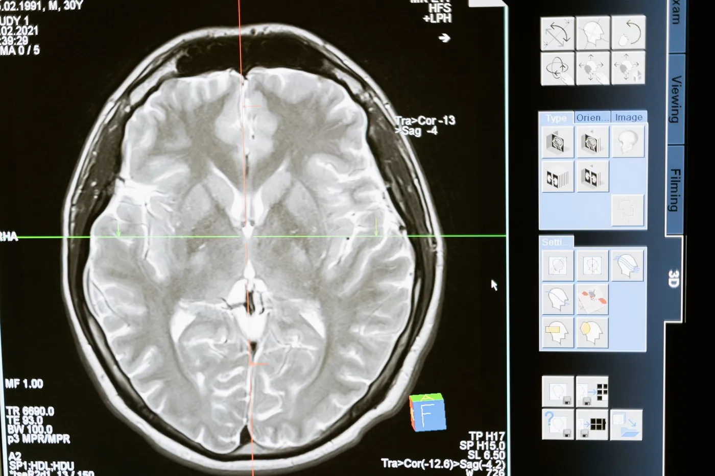 A brain MRI scan on a monitor